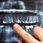 Dental X-Rays