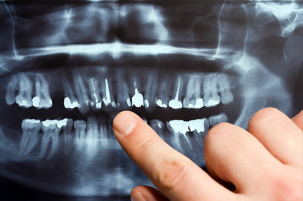 Why Do Dentists Take X-rays? – Highland, MI