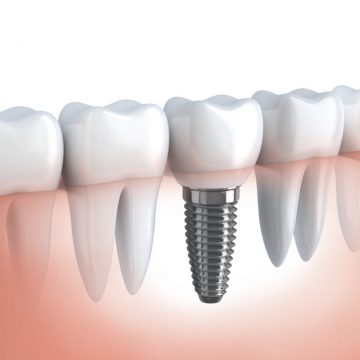 Need to Know More About Dental Implants? We’ve Got You Covered!