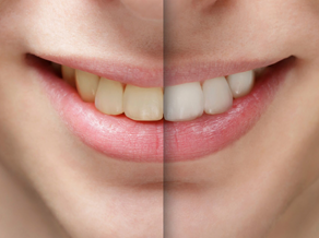 before and after image of whitened teeth