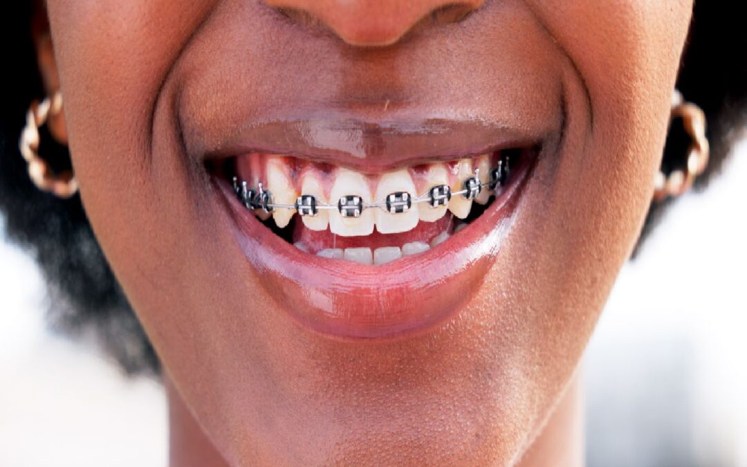 How Long Does It Take to Get Braces?