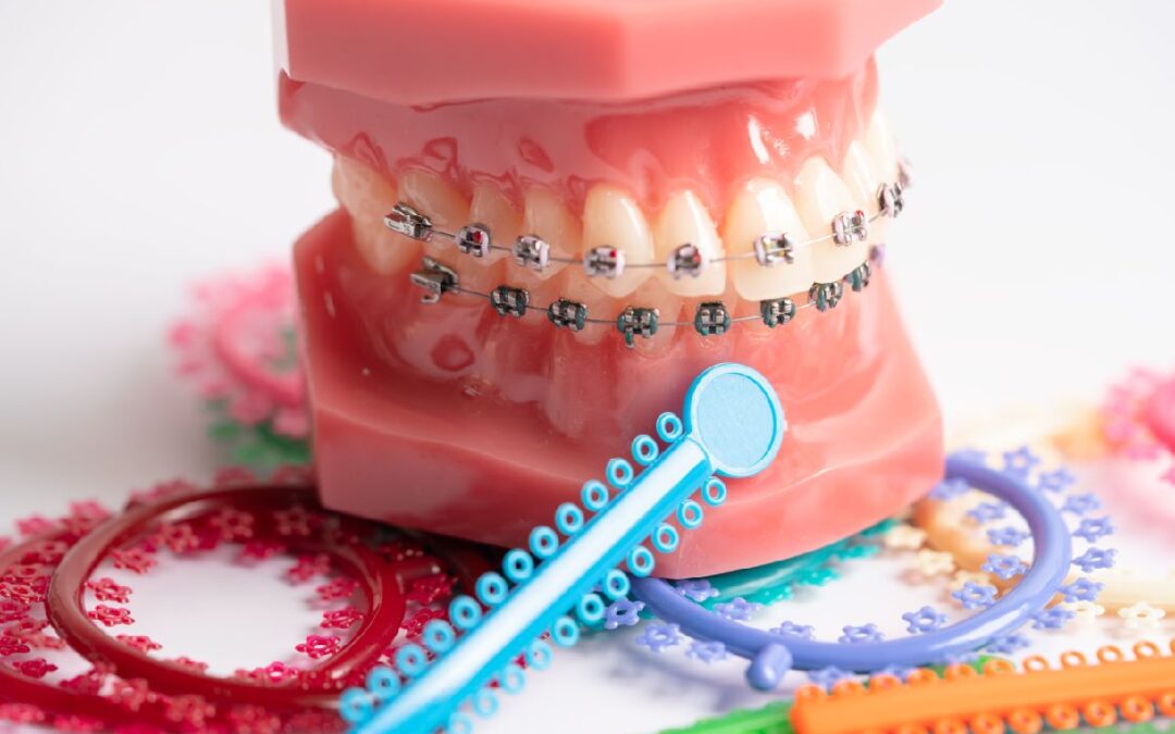 Can You Get Braces With Dental Implants?