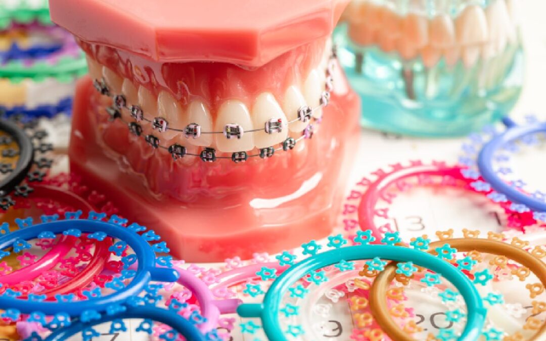 How Much Do Braces Cost? A Complete Guide