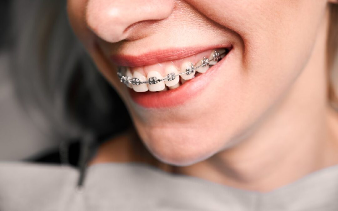 Are Metal Braces Better Than Clear Braces?
